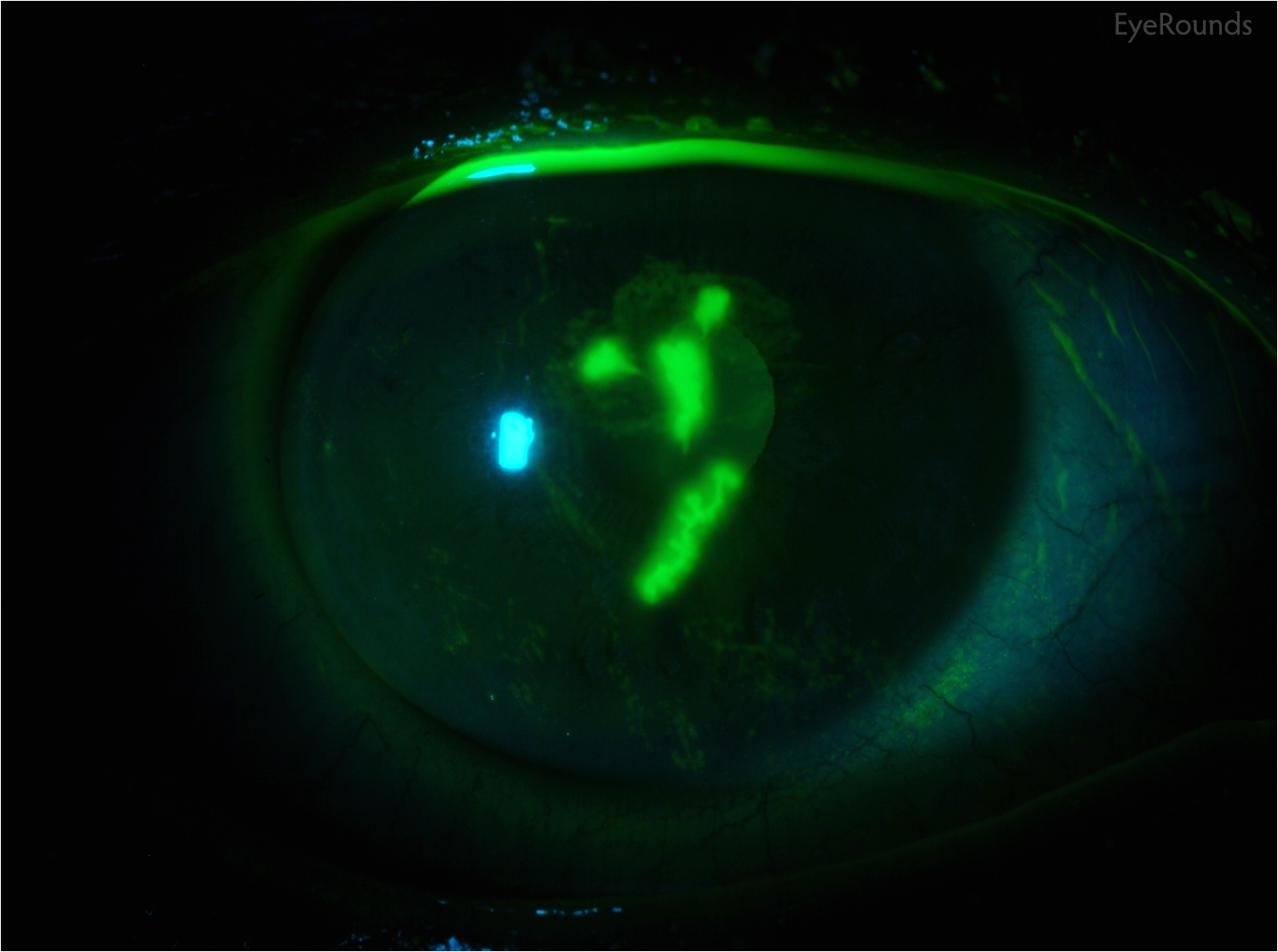slit lamp photo classic epithelial dendrites after fluorescein staining