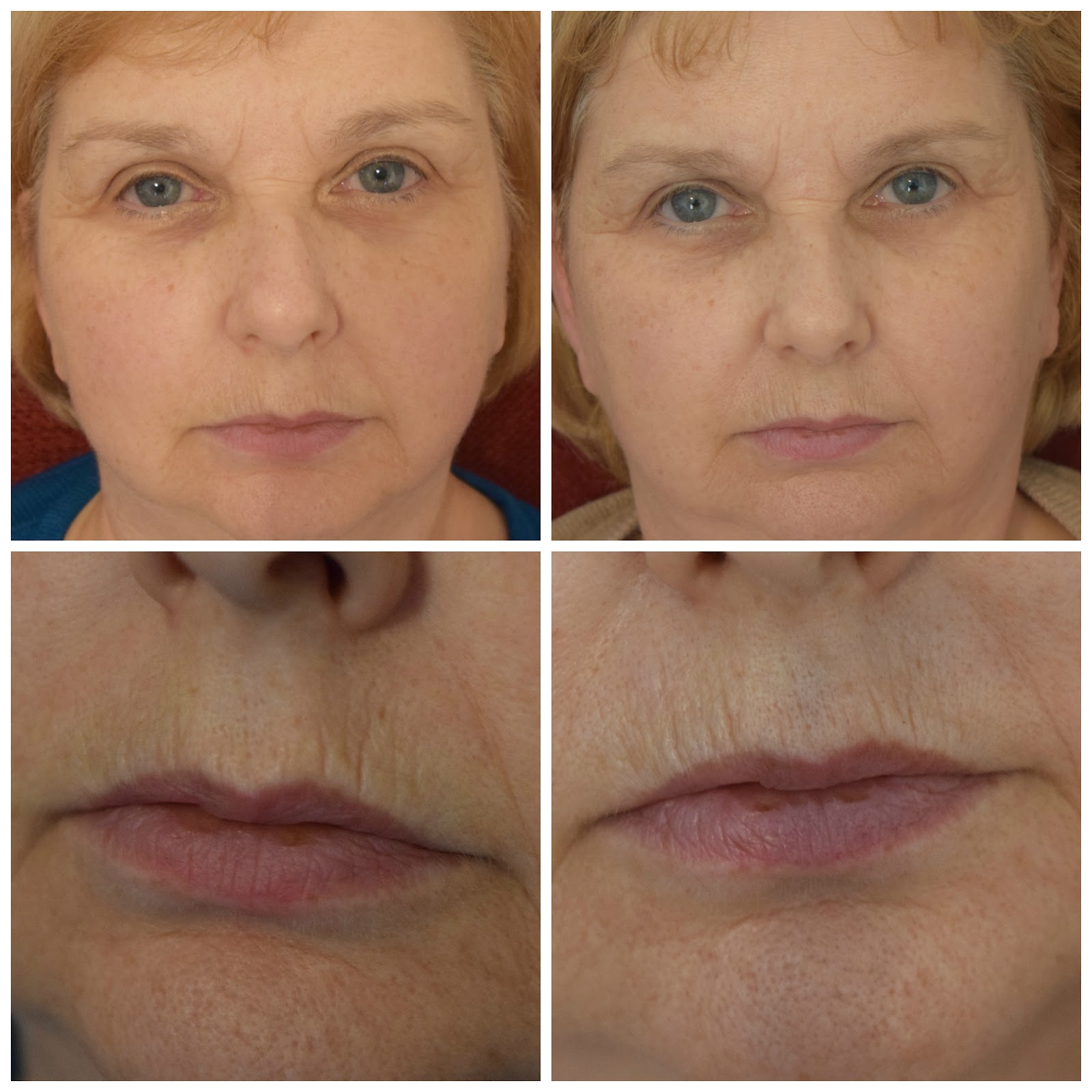 lightstim for wrinkles before after