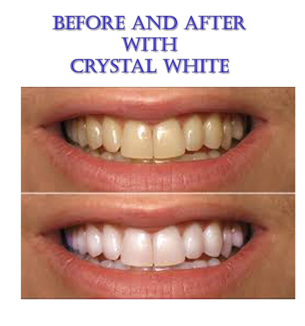 amazon com pre loaded crystal white professional teeth whitening system 3 preloaded trays no mess 35 carbamide peroxide made in the usa fda approved