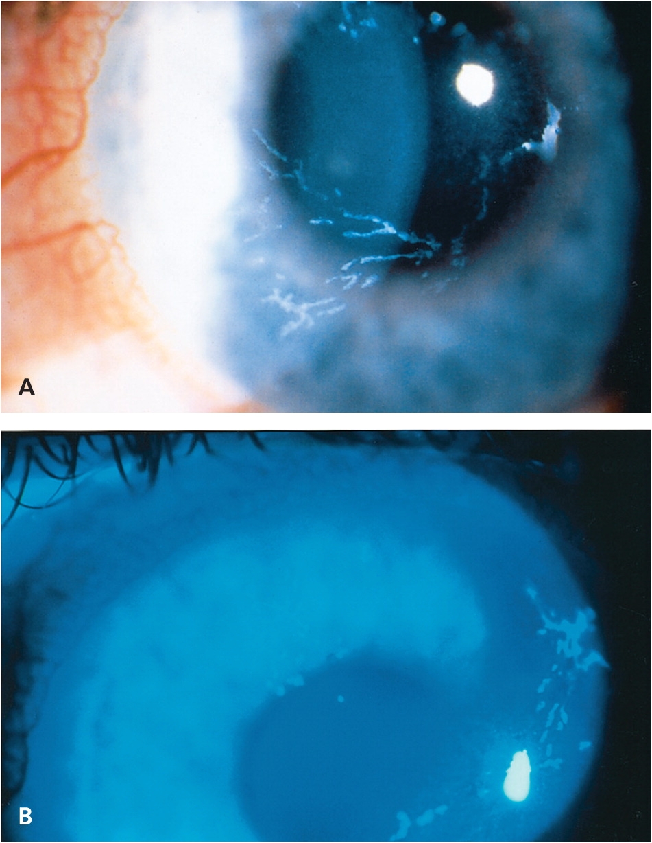 figure 4 slit lamp examination