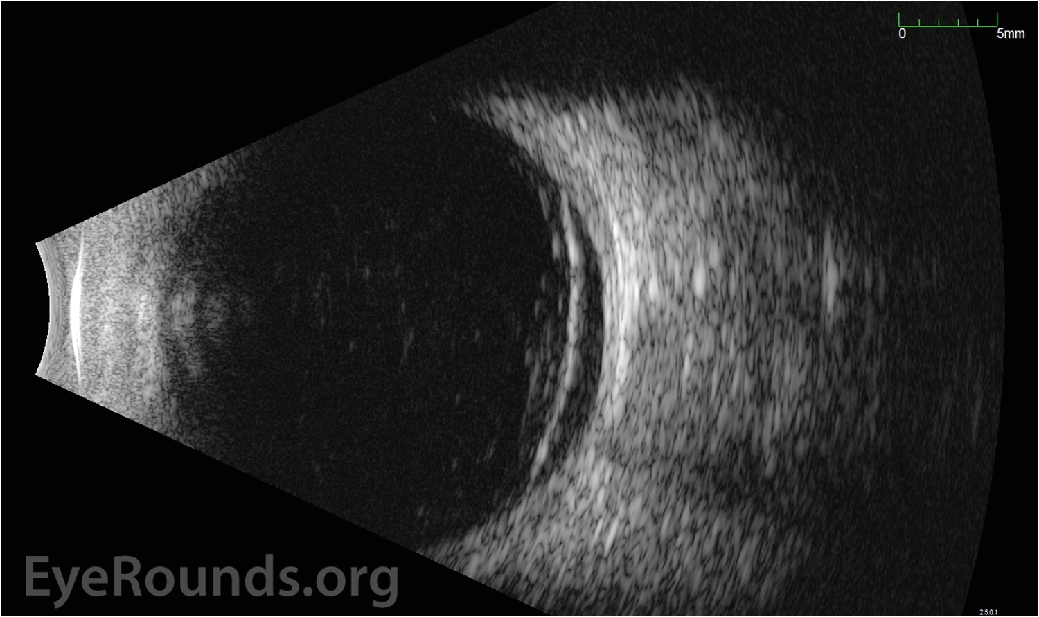 standardized echography od transverse view with nasal quadrant centered at 3 oclock