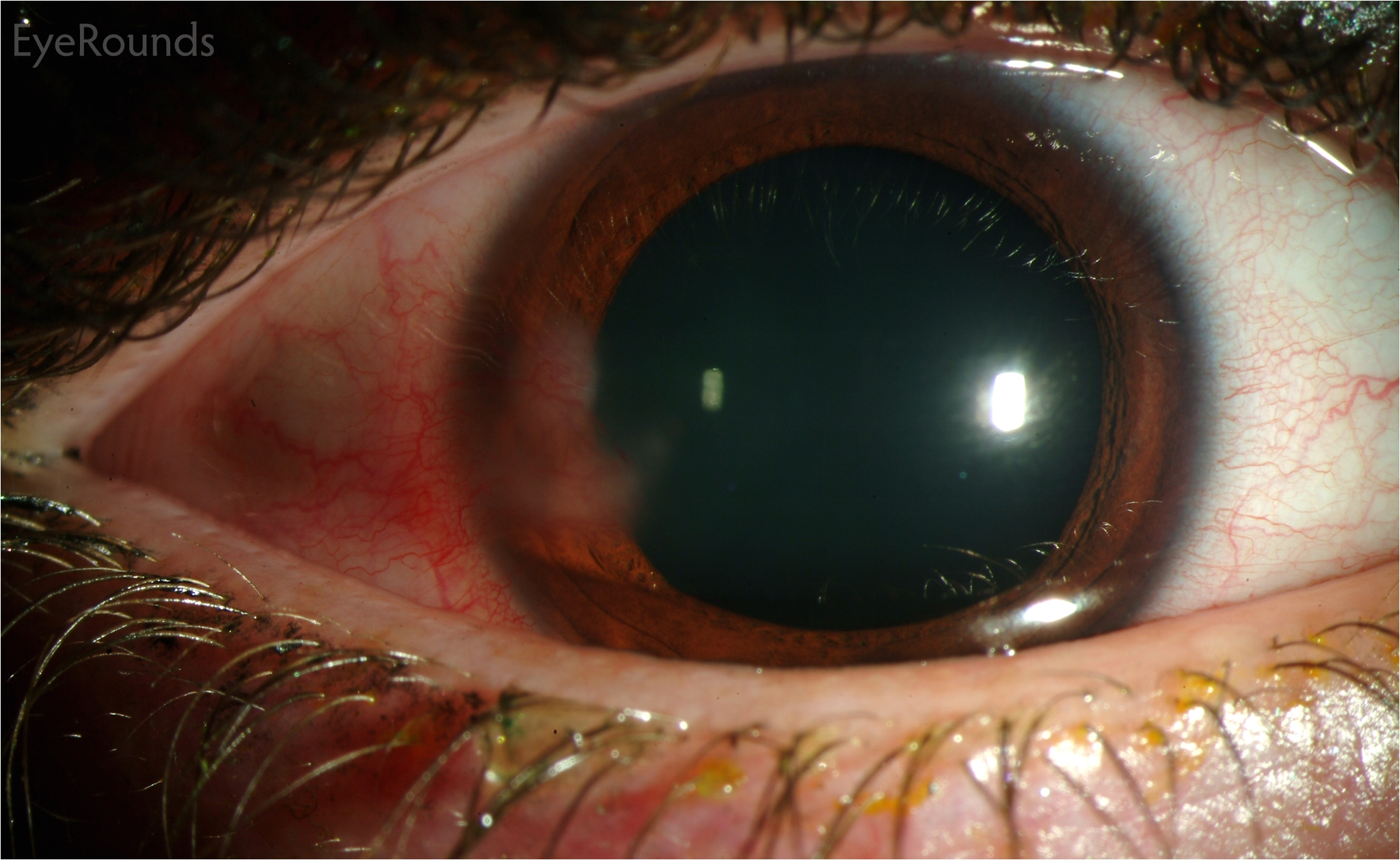 hsv stromal keratitis with resultant stromal vascularization