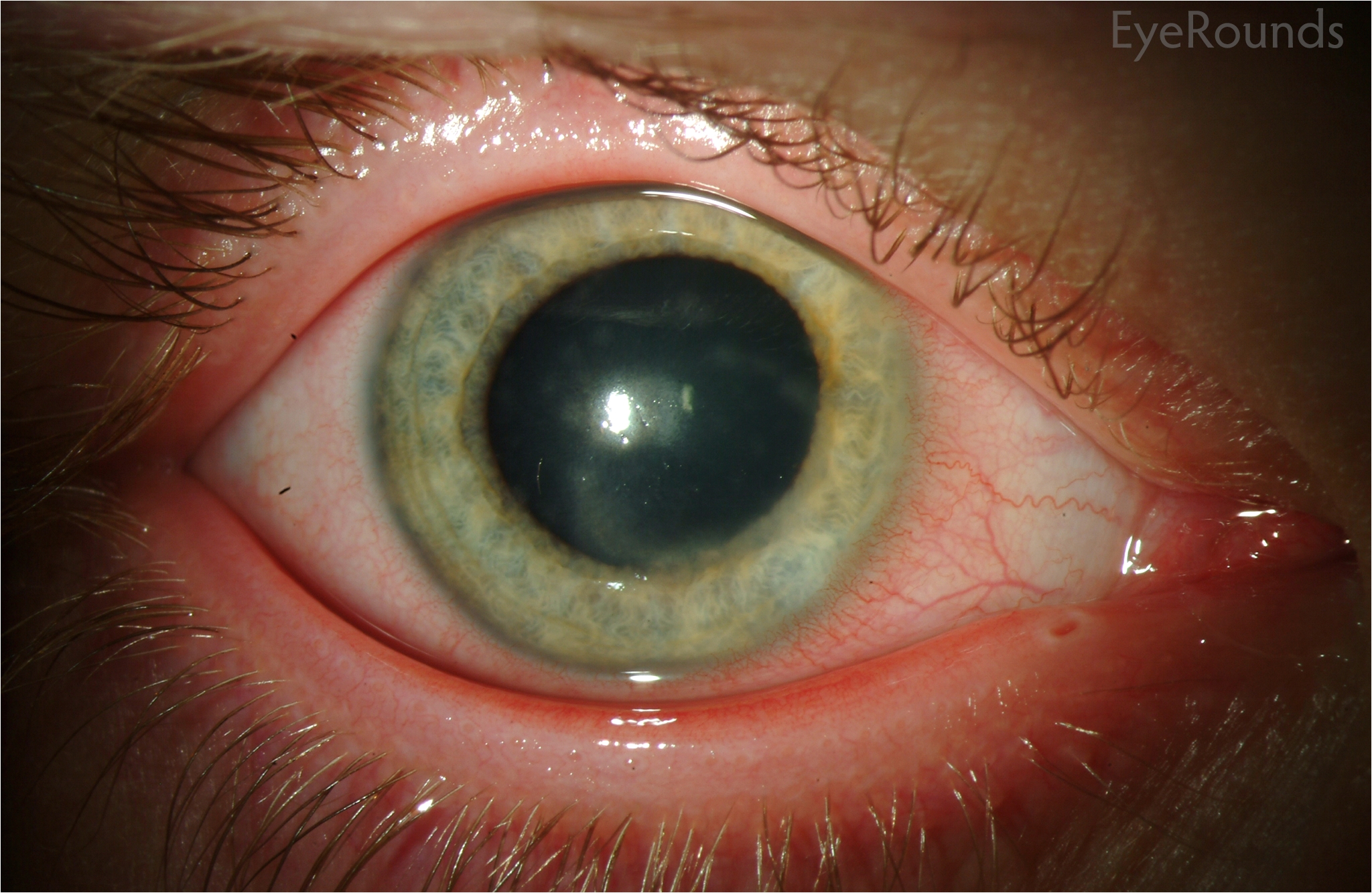 classic immune stromal keratitis with mid deep stromal infiltration and intact epithelium