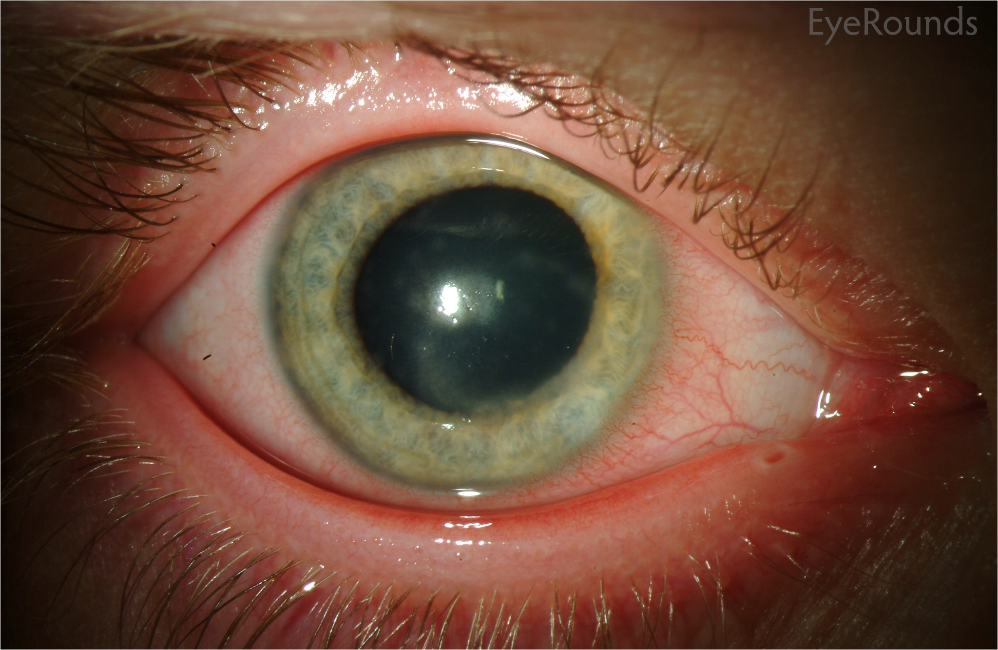 Woods Lamp Eye Herpes Simplex Keratitis