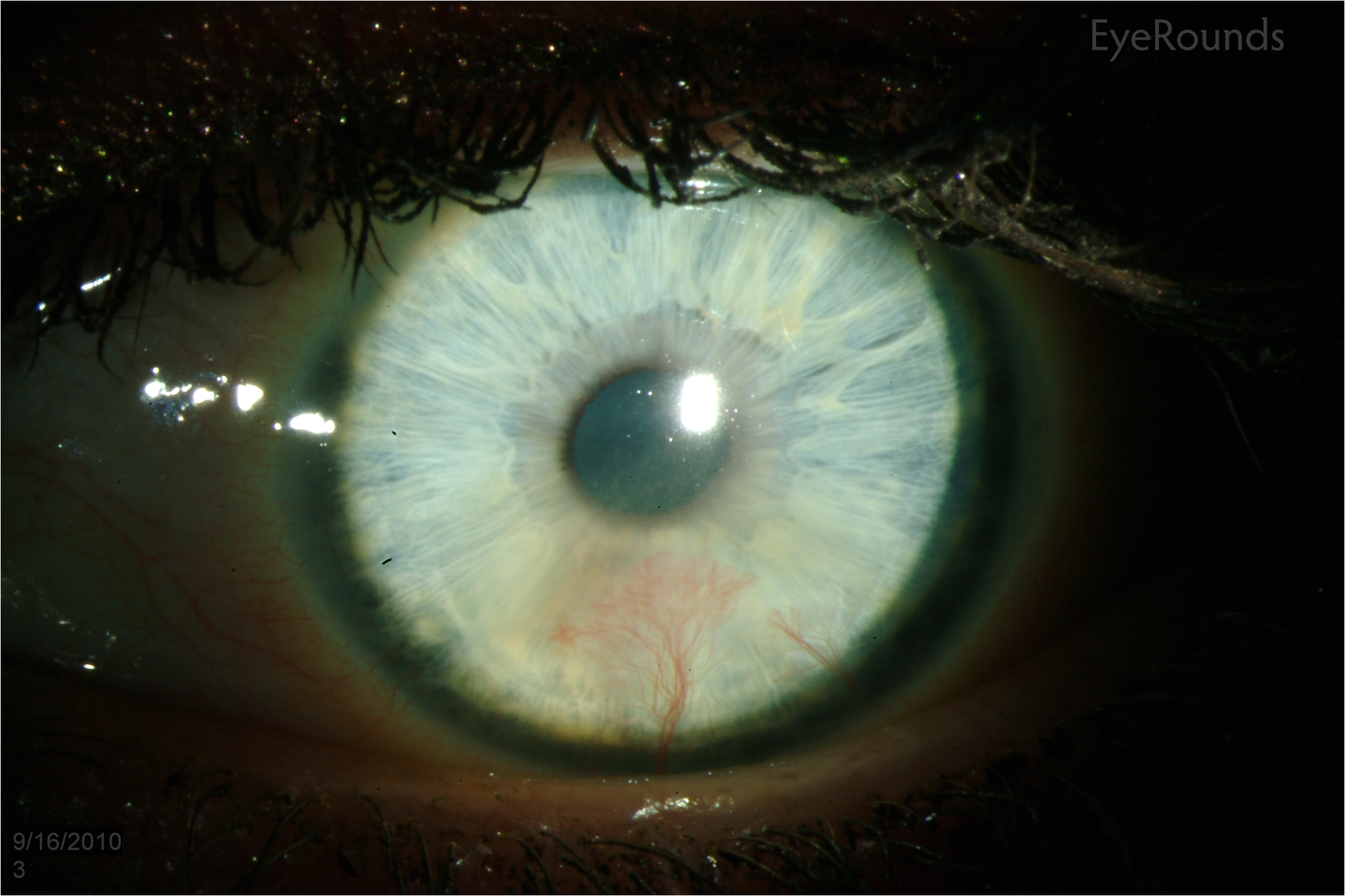 hsv stromal keratitis with resultant stromal vascularization