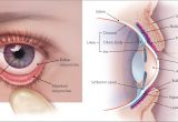 How to Use Woods Lamp Eye Evaluation Of the Painful Eye American Family Physician