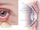 How to Use Woods Lamp Eye Evaluation Of the Painful Eye American Family Physician