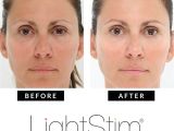 Light Stim Reviews Lightstim for Wrinkles