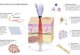 Lipo Light Treatment Lipo Light Treatment How to Lose Weight Fast Mind therapy