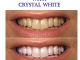Teeth Whitening Light Reviews Amazon Com Pre Loaded Crystal White Professional Teeth Whitening