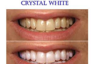 Teeth Whitening Light Reviews Amazon Com Pre Loaded Crystal White Professional Teeth Whitening