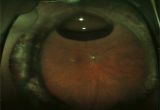 Woods Lamp Eye Exam Cpt Vitrectomy the American society Of Retina Specialists the