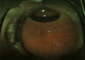Woods Lamp Eye Exam Cpt Vitrectomy the American society Of Retina Specialists the