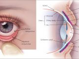 Woods Lamp Eye Examination Evaluation Of the Painful Eye American Family Physician