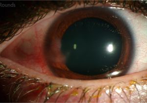 Woods Lamp Eye Examination Herpes Simplex Keratitis