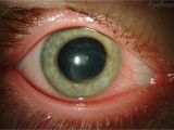 Woods Lamp Eye Examination Herpes Simplex Keratitis