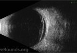 Woods Lamp Eye Examination Retinal Dialysis