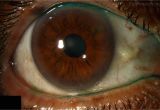 Woods Lamp Eye Examination Superior Limbic Keratitis