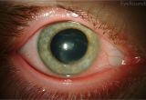 Woods Lamp Eye Herpes Simplex Keratitis